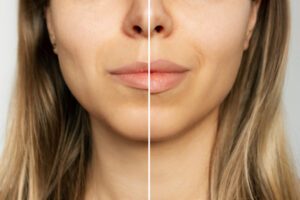 Before and after of woman's lips after receiving lip injections in Boca Raton at The Herscthal Practice