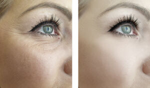 Woman's eyes and cheek facial wrinkles before and after dermal filler treatment in Boca Raton